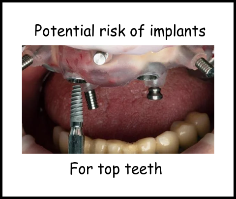 Potential risks of dental implants for top teeth image