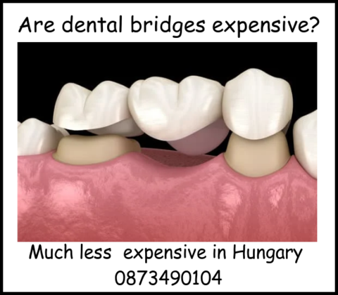 Are dental bridges expensive image