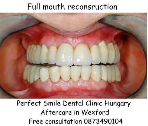 Full mouth reconstruction image