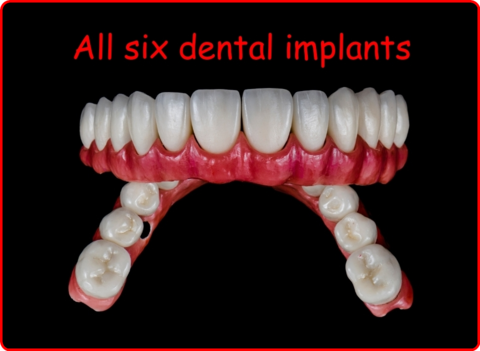 All six dental implants image