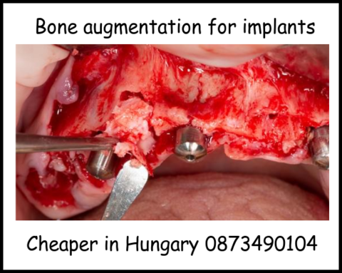 Bone augmentation for implants image 1