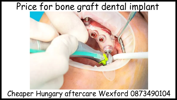 Price for bone graft for dental implants image