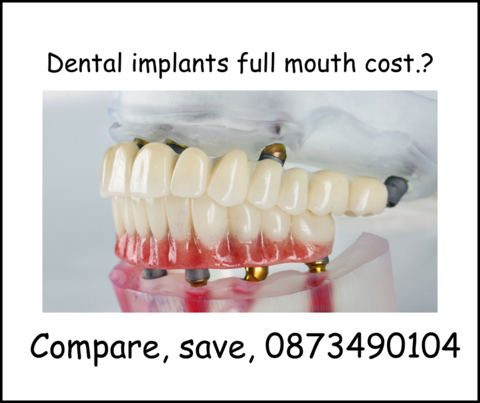 Dental implants full mouth cost image