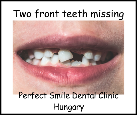 Two front teeth missing your options image