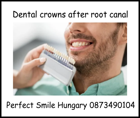 Dental crowns after root canals image