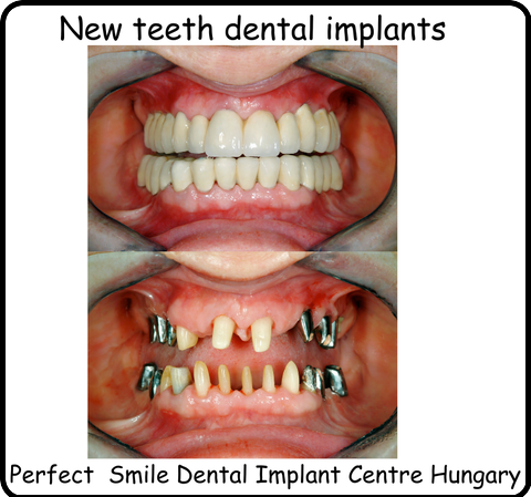 New teeth dental implants image