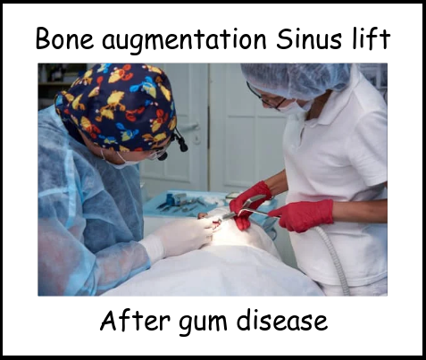 Bone augmentation sinus lift after gum disease image 