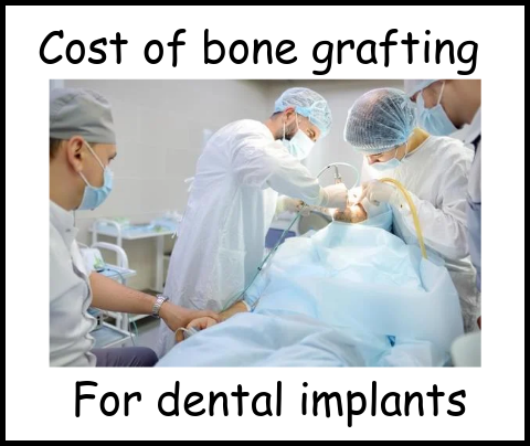 Cost of bone grafting for dental implants image