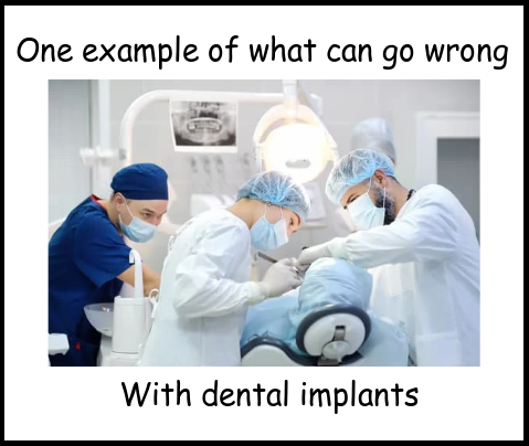 dental implants procedure image