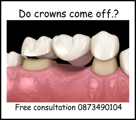 Do crowns come out image