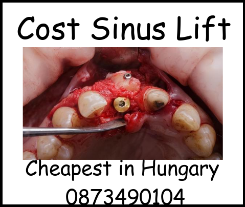 Cost Sinus Lift image