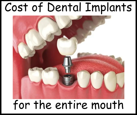 Cost of dental implants for the entire mouth image