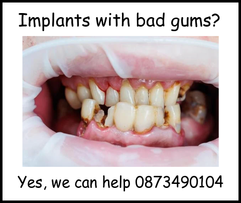 Implants with bad gums image