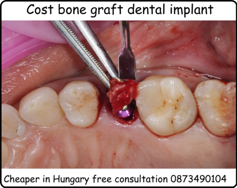 Cost bone graft dental implant cheaper in Hungary image