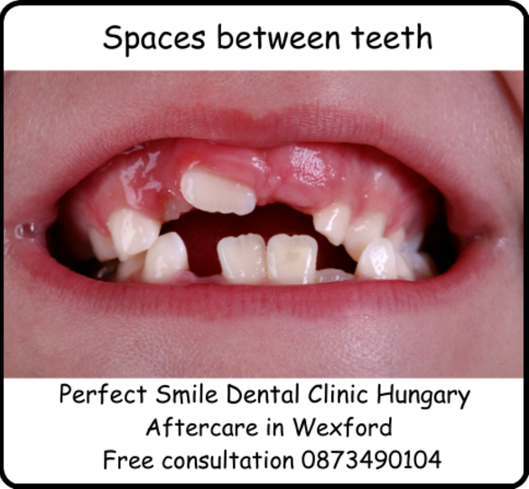 Spaces between teeth image 