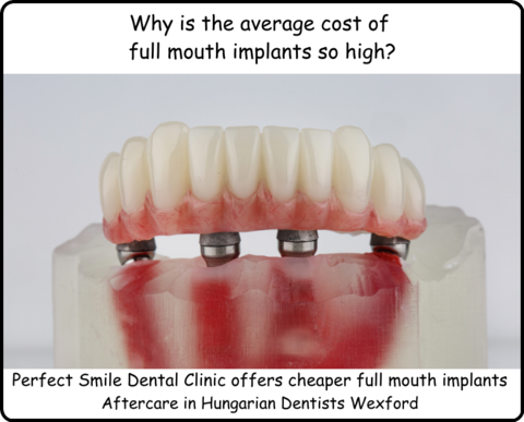 Why is the average cost of full mouth implants so high image