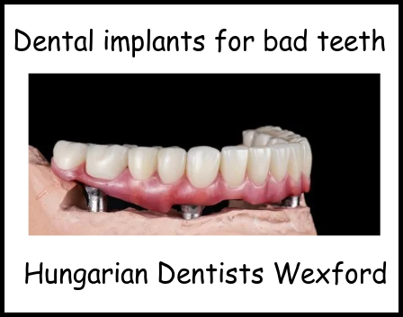 Dental implants for bad teeth image