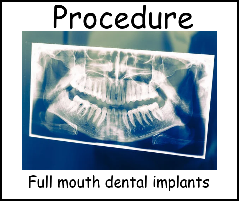 Procedure full mouth dental implants image