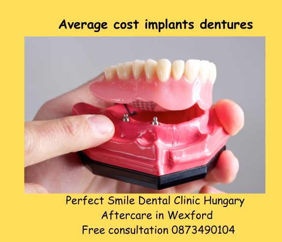 Average cost implants dentures image