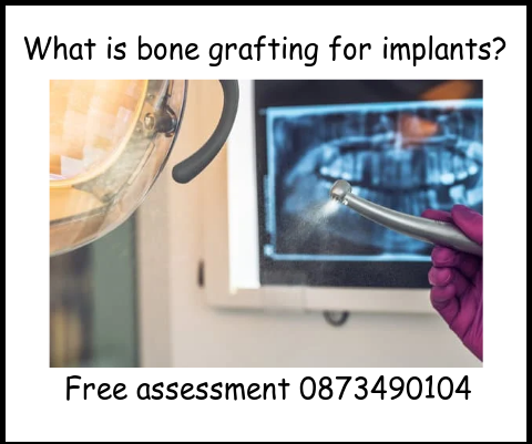 What is bone grafting for dental implants image