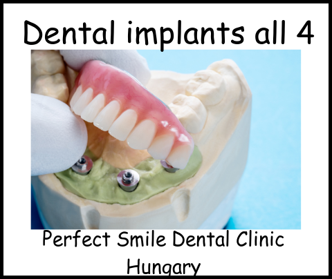 Dental implants all 4 image