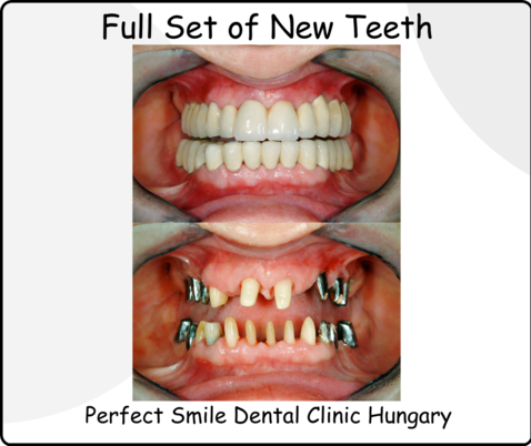 Perfect Smile dental clinic Hungary full set of new teeth image