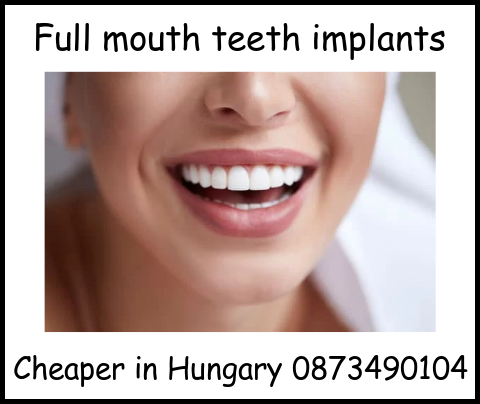 Full mouth teeth implants image 1