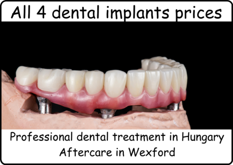 All 4 dental implants prices image 