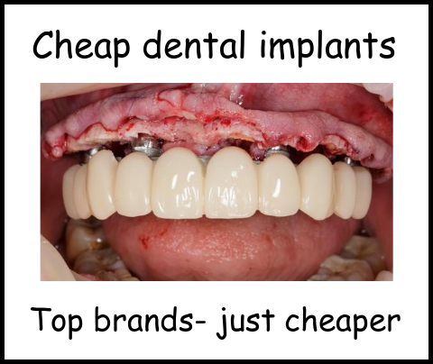 Cheap dental implants image