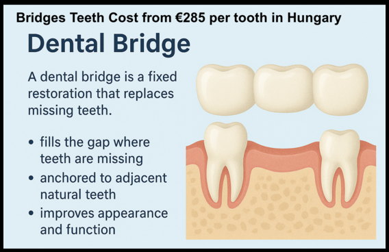 Bridges teeth cost image 