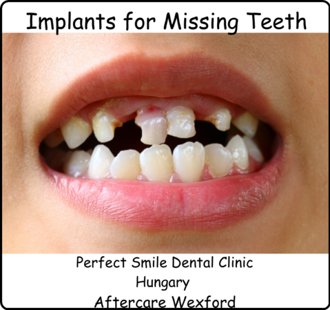 Implants for missing teeth image