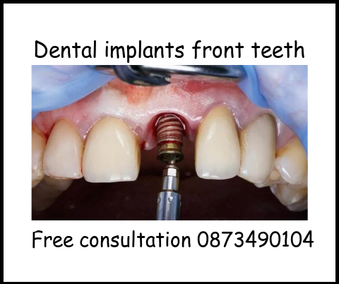 Dental implants front teeth image