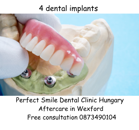 4 dental implants image