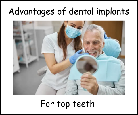 Advantages of dental implants for top teeth