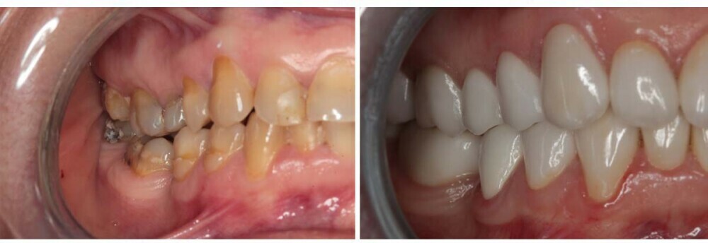 Before and after dental treatment image