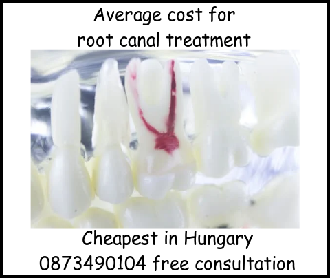 Average cost for root canal treatment image