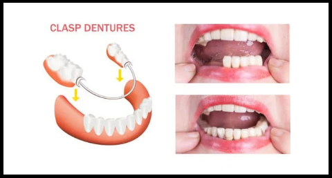 Clasp dentures image