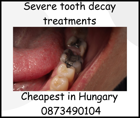 Severe tooth decay treatments image