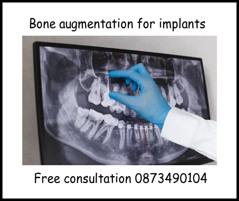 Bone augmentation for implants image 2