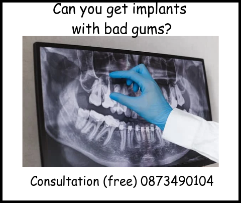 Can you get implants with bad gums image