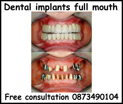 Dental implants full mouth image