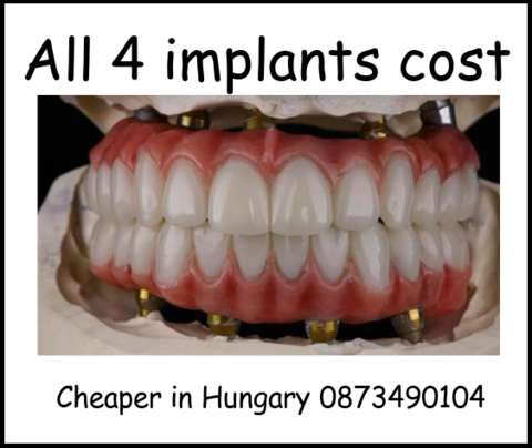 All 4 implants cost image