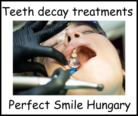 Teeth decay treatments Perfect Smile Hungary image