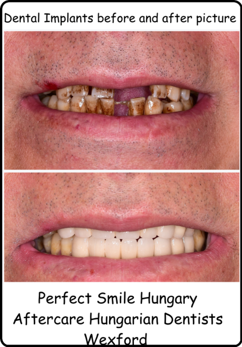 Dental implants before and after photo image