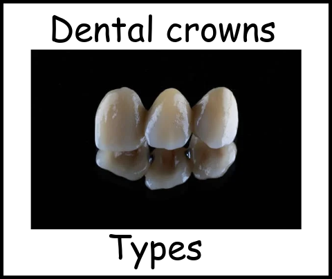 Dental crowns types image