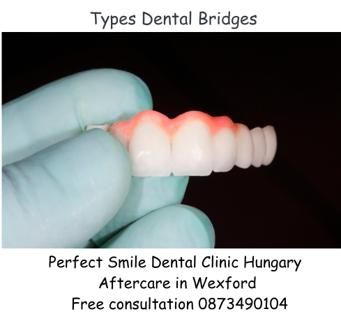 Types of dental bridges image