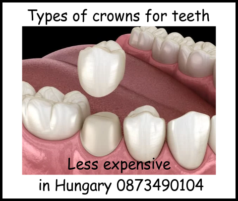 Types of crowns for teeth image