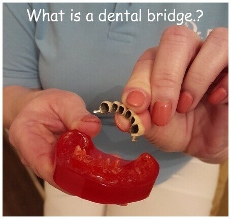 What is a dental bridge image