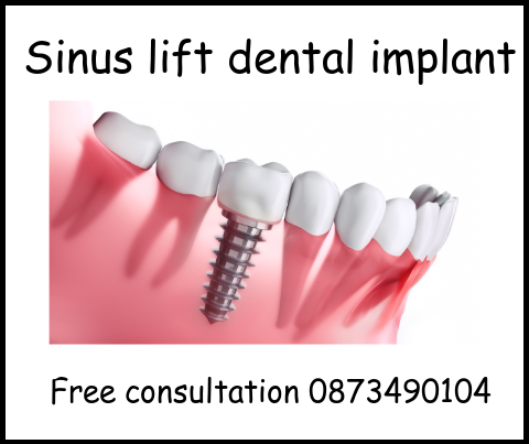 Sinus lift dental implant image