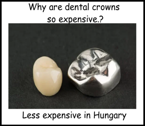 Why are dental crowns so expensive image